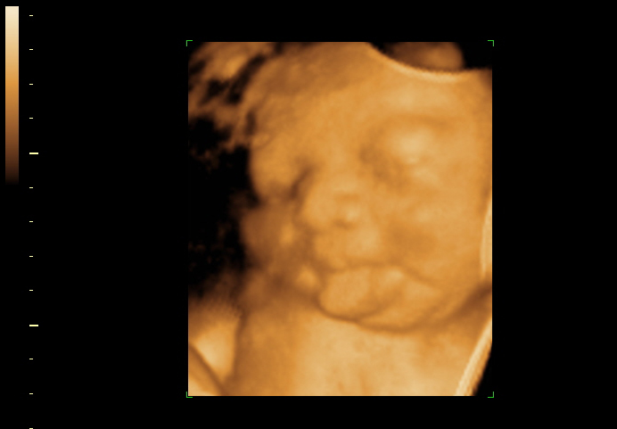 3D ultrasound image at 36 weeks